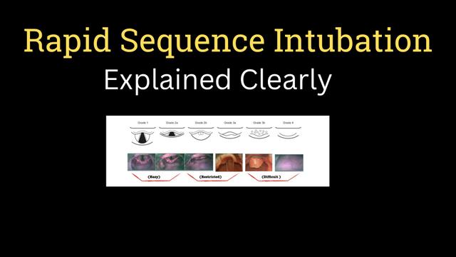 Rapid sequence intubation
